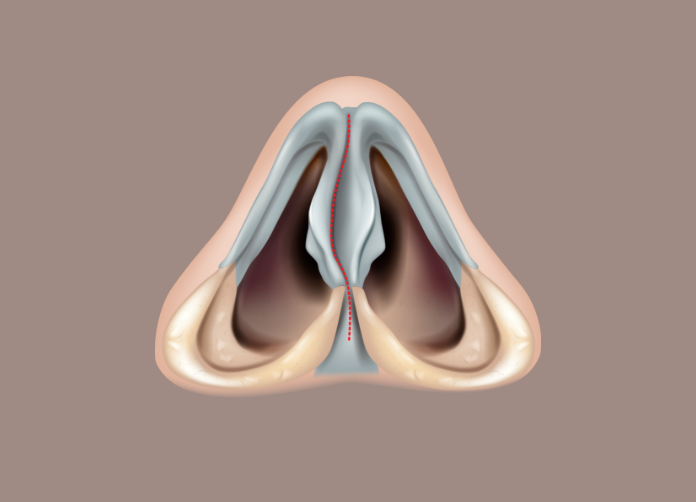 Cross-section of the nose showing a deviated septum narrowing one nasal passage