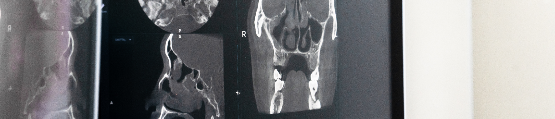 CT scans of the nose and sinuses