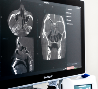 CT scans of the nose and sinuses
