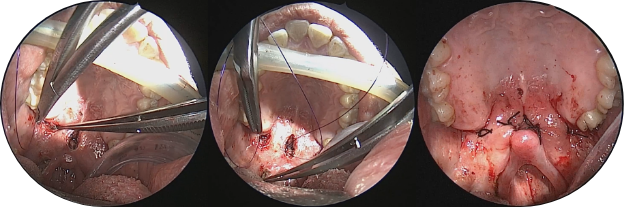 Intraoperative views of upper airway surgery
